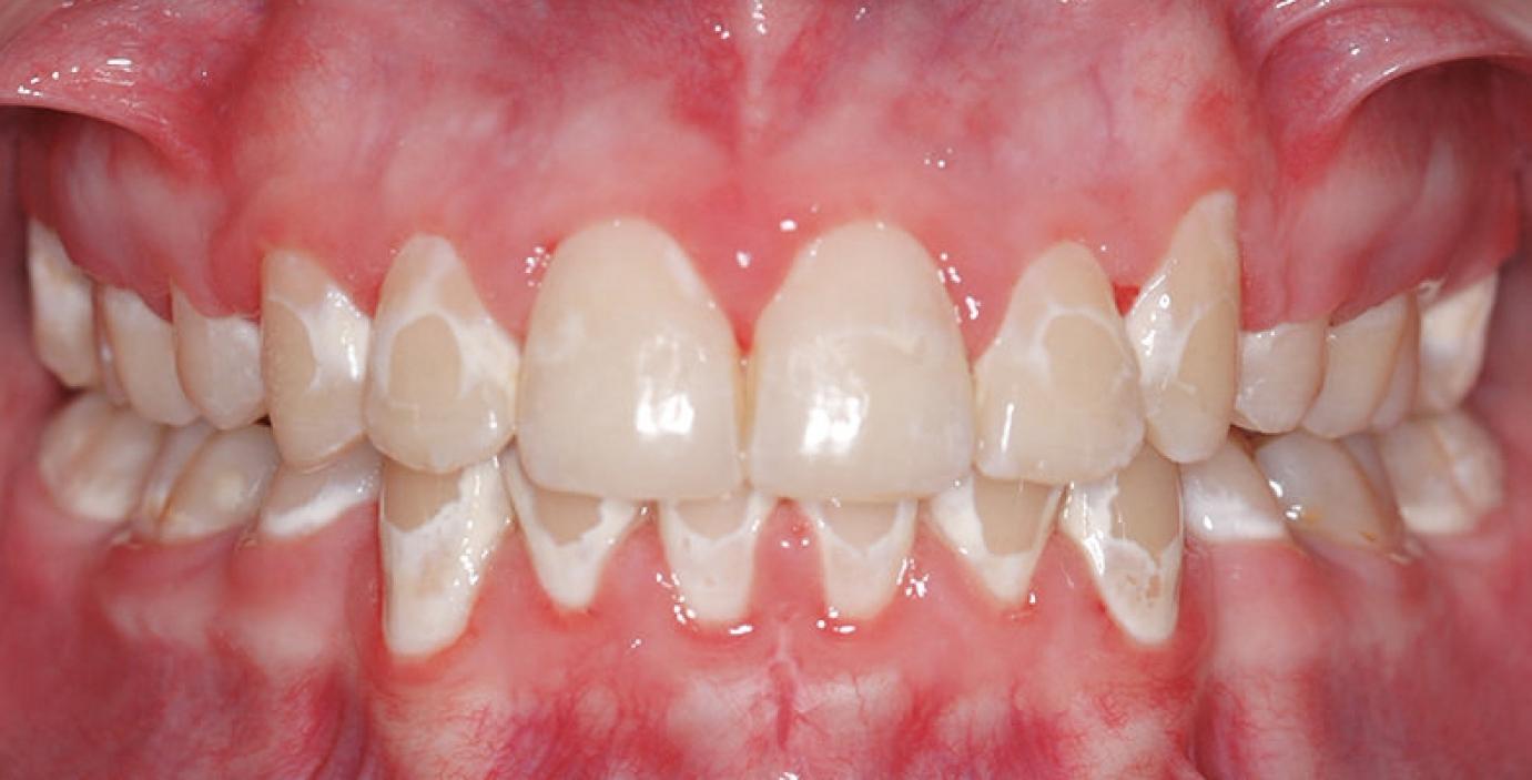 White spot elváltozás