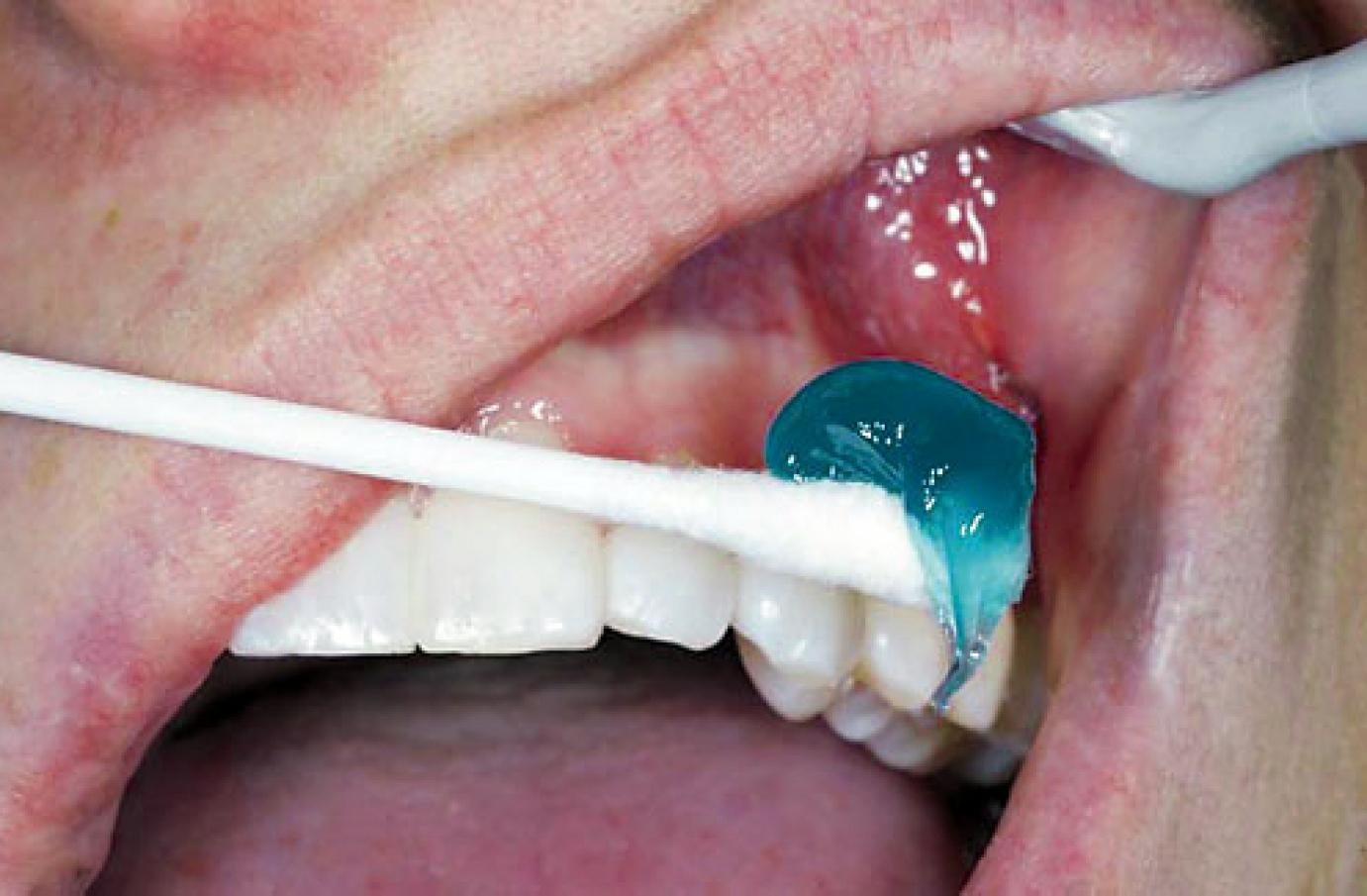 Felületi érzéstelenítés