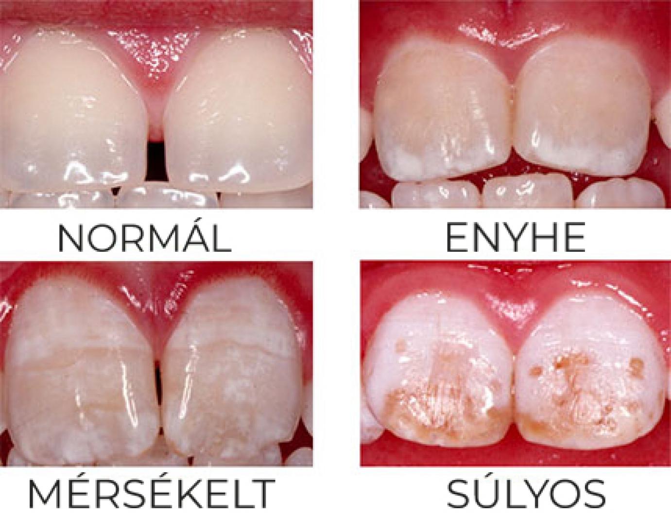 Fluorosis