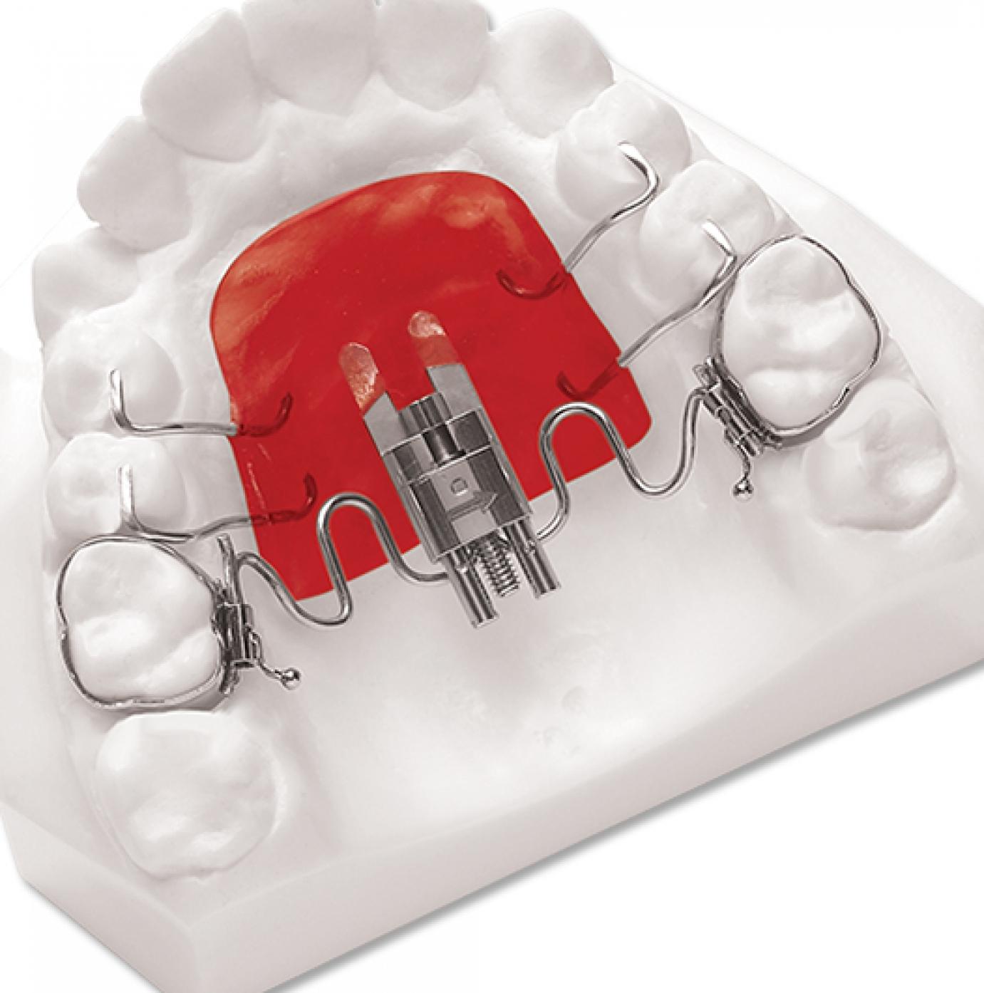 Frog fogszabályozó készülék