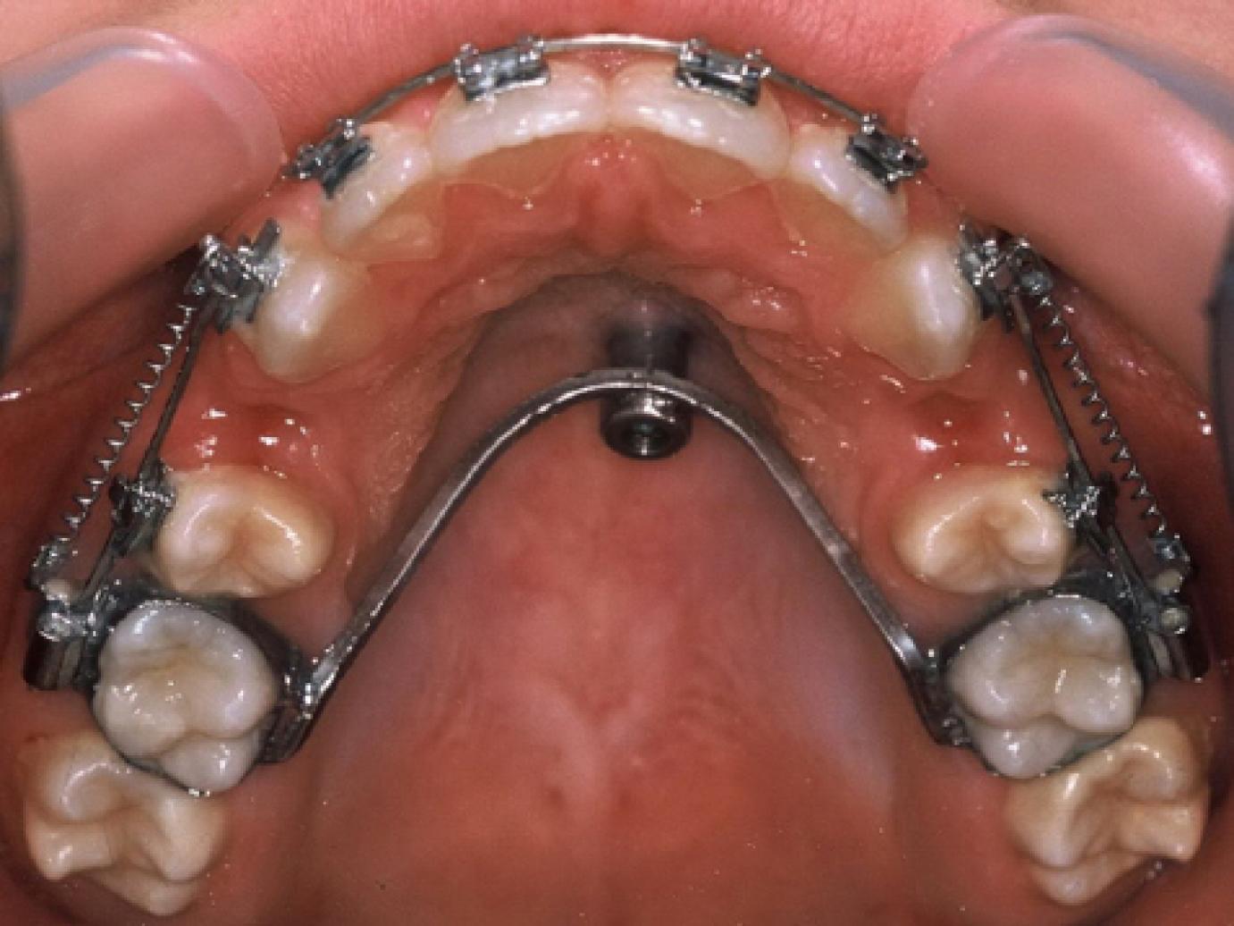 Hibrid transpalatinal ív