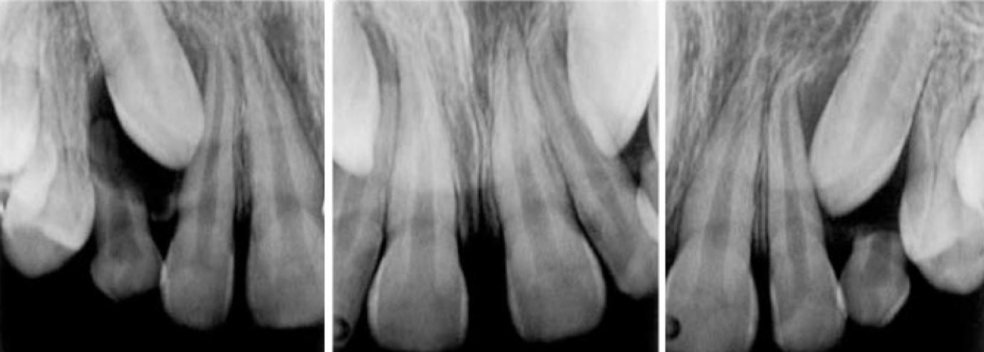 Irányított fogváltás