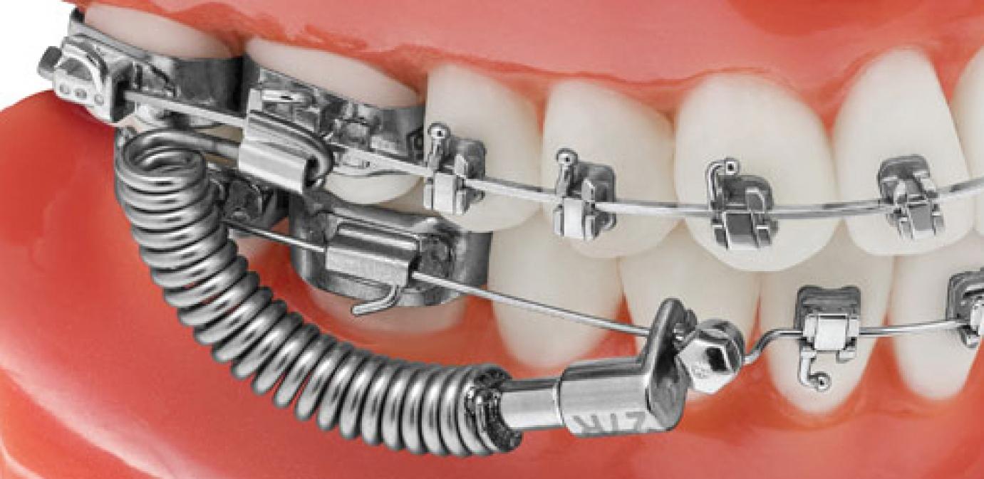 Jasper-jumper fogszabályozó készülék