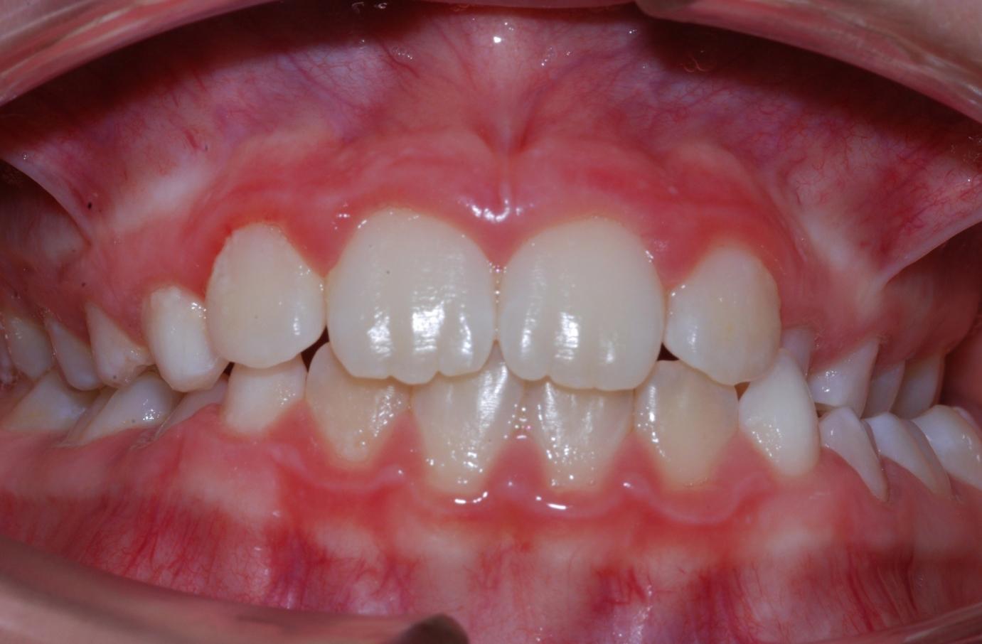 Oldalsó teljes keresztharapás