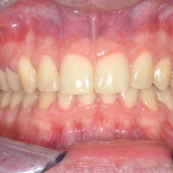 Kezelés után - szemből