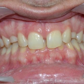 Kezelés előtt - szemből