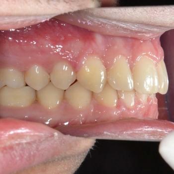 Kezelés után - jobb oldalról