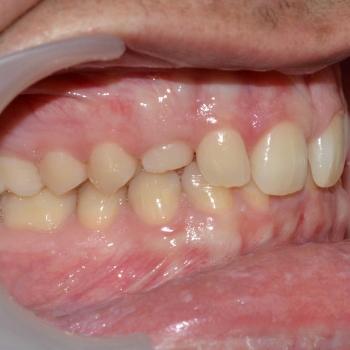 Kezelés előtt - jobb oldalról