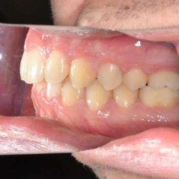 Kezelés után - bal oldalról