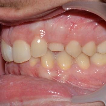 Kezelés előtt - bal oldalról