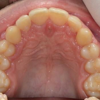 Kezelés után - felső rágófelszín