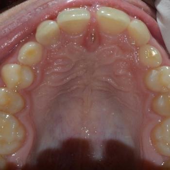 Kezelés előtt - felső rágófelszín