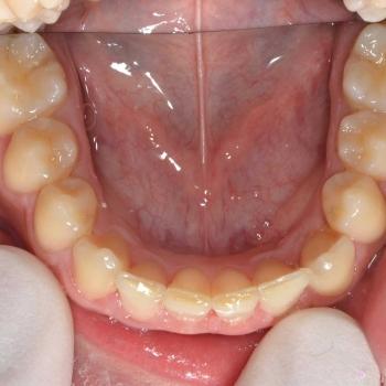 Kezelés után - alsó rágófelszín