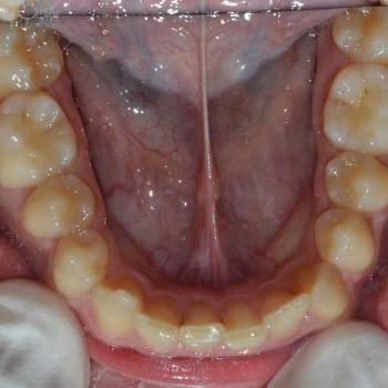 Kezelés előtt - alsó rágófelszín