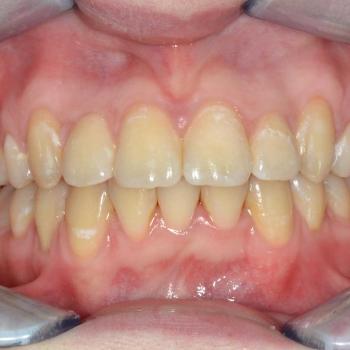 Kezelés után - szemből