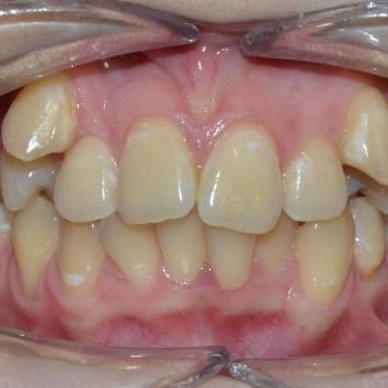 Kezelés előtt - szemből