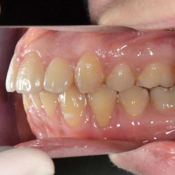 Kezelés után - jobb oldalról