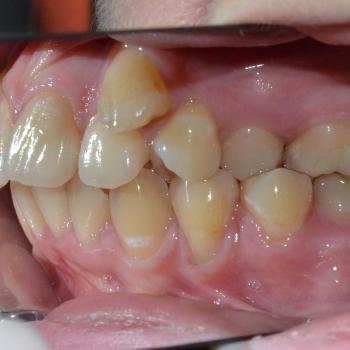 Kezelés előtt - jobb oldalról