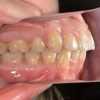 Kezelés után - bal oldalról