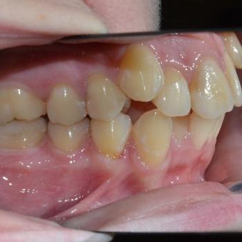 Kezelés előtt - bal oldalról