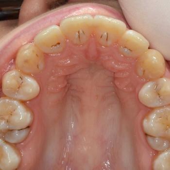 Kezelés után - felső rágófelszín