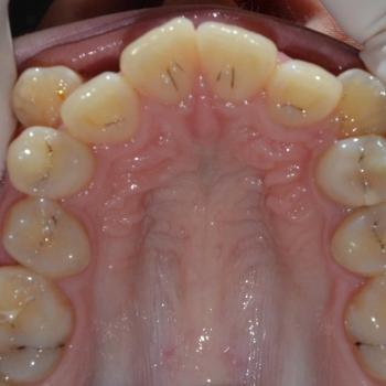 Kezelés előtt - felső rágófelszín