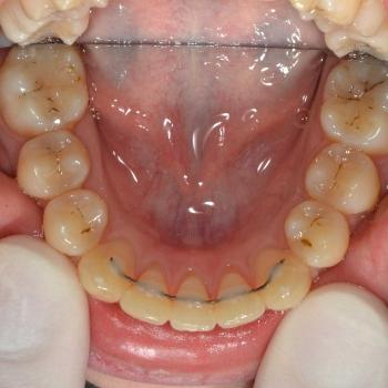 Kezelés után - alsó rágófelszín