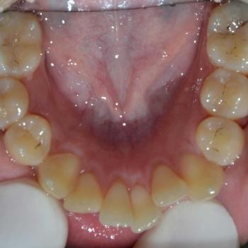 Kezelés előtt - alsó rágófelszín