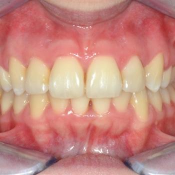 Kezelés után - szemből