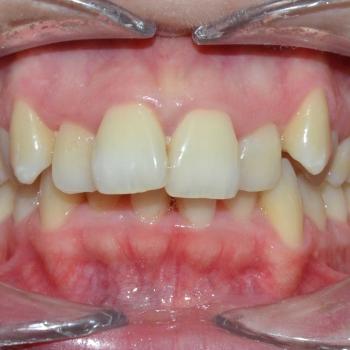 Kezelés előtt - szemből