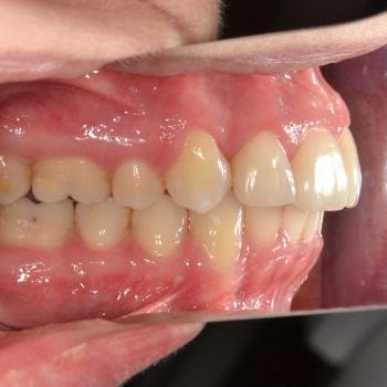 Kezelés után - bal oldalról