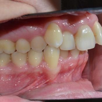 Kezelés előtt - bal oldalról