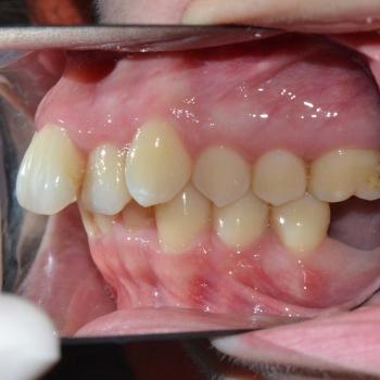 Kezelés előtt - jobb oldalról