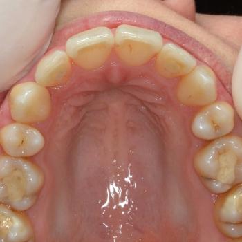 Kezelés után - felső rágófelszín