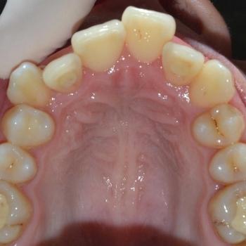 Kezelés előtt - felső rágófelszín