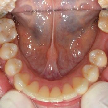 Kezelés után - alsó rágófelszín