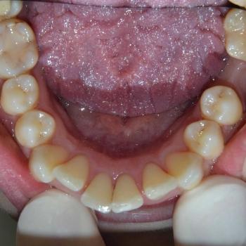 Kezelés előtt - alsó rágófelszín