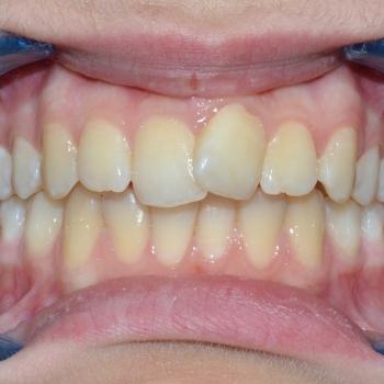 Kezelés előtt - szemből