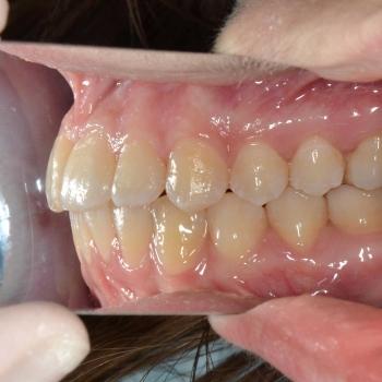 Kezelés után - jobb oldalról