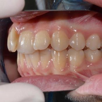 Kezelés előtt - jobb oldalról