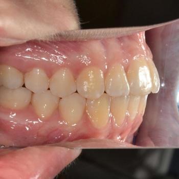 Kezelés után - bal oldalról