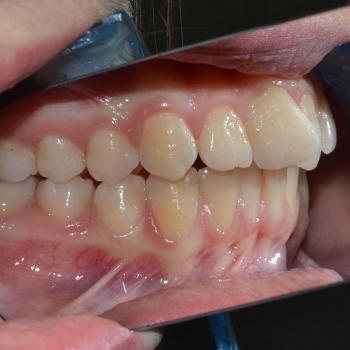 Kezelés előtt - bal oldalról