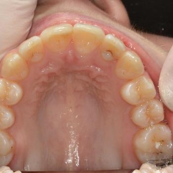 Kezelés után - felső rágófelszín