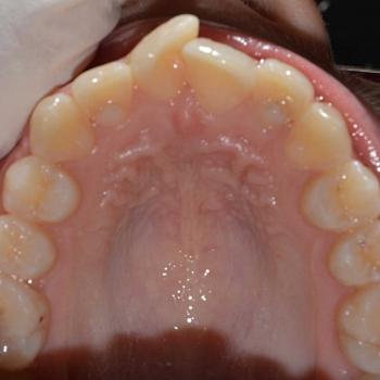 Kezelés előtt - felső rágófelszín