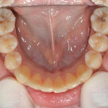 Kezelés után - alsó rágófelszín