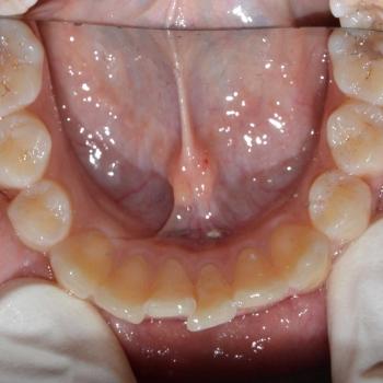 Kezelés előtt - alsó rágófelszín