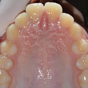 Kezelés előtt - felső rágófelszín