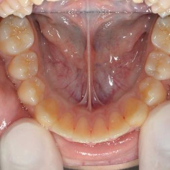 Kezelés után - alsó rágófelszín