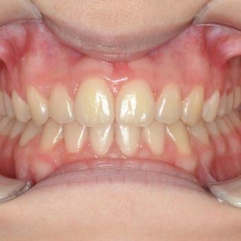 Kezelés után - szemből