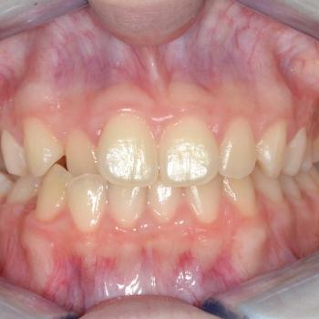 Kezelés előtt - szemből